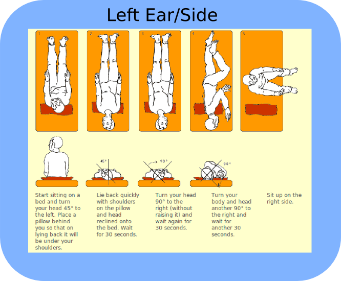 Epley maneuver instructions handout