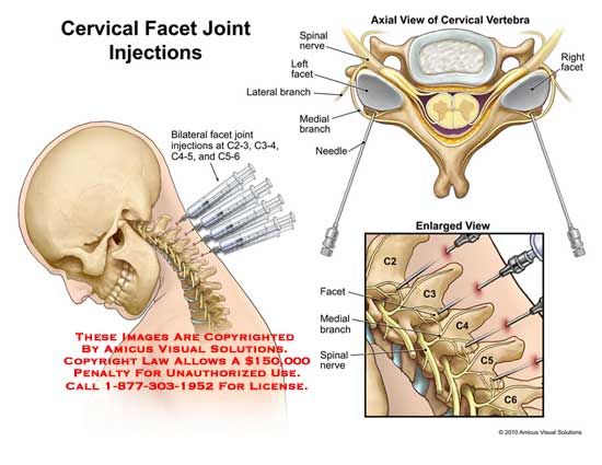 C6 c7 ct guided injection