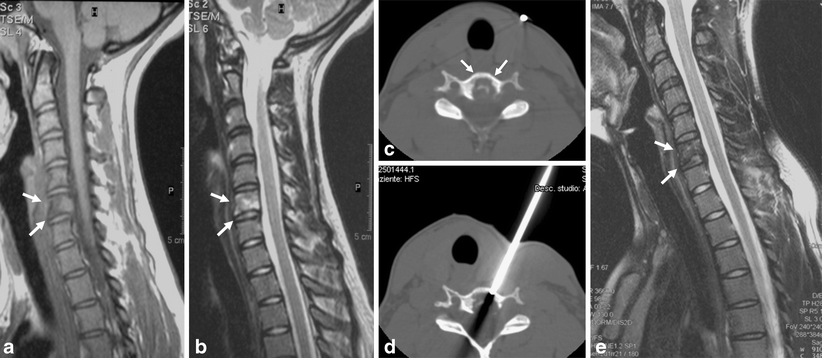 C6 c7 ct guided injection