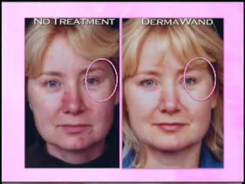 instructions for using dermawand