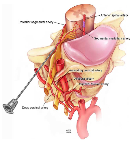 C6 c7 ct guided injection