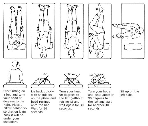 Epley maneuver instructions handout