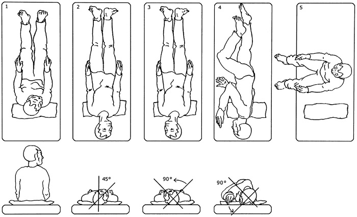 Epley maneuver instructions handout