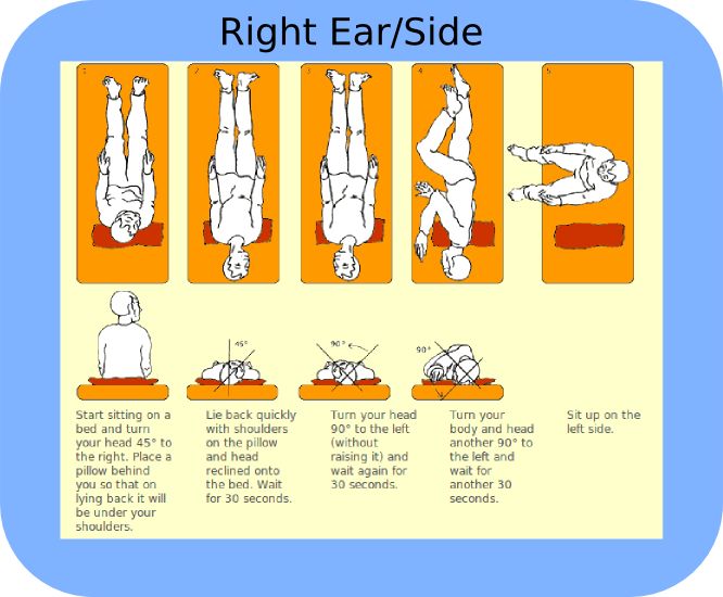 Epley maneuver instructions handout